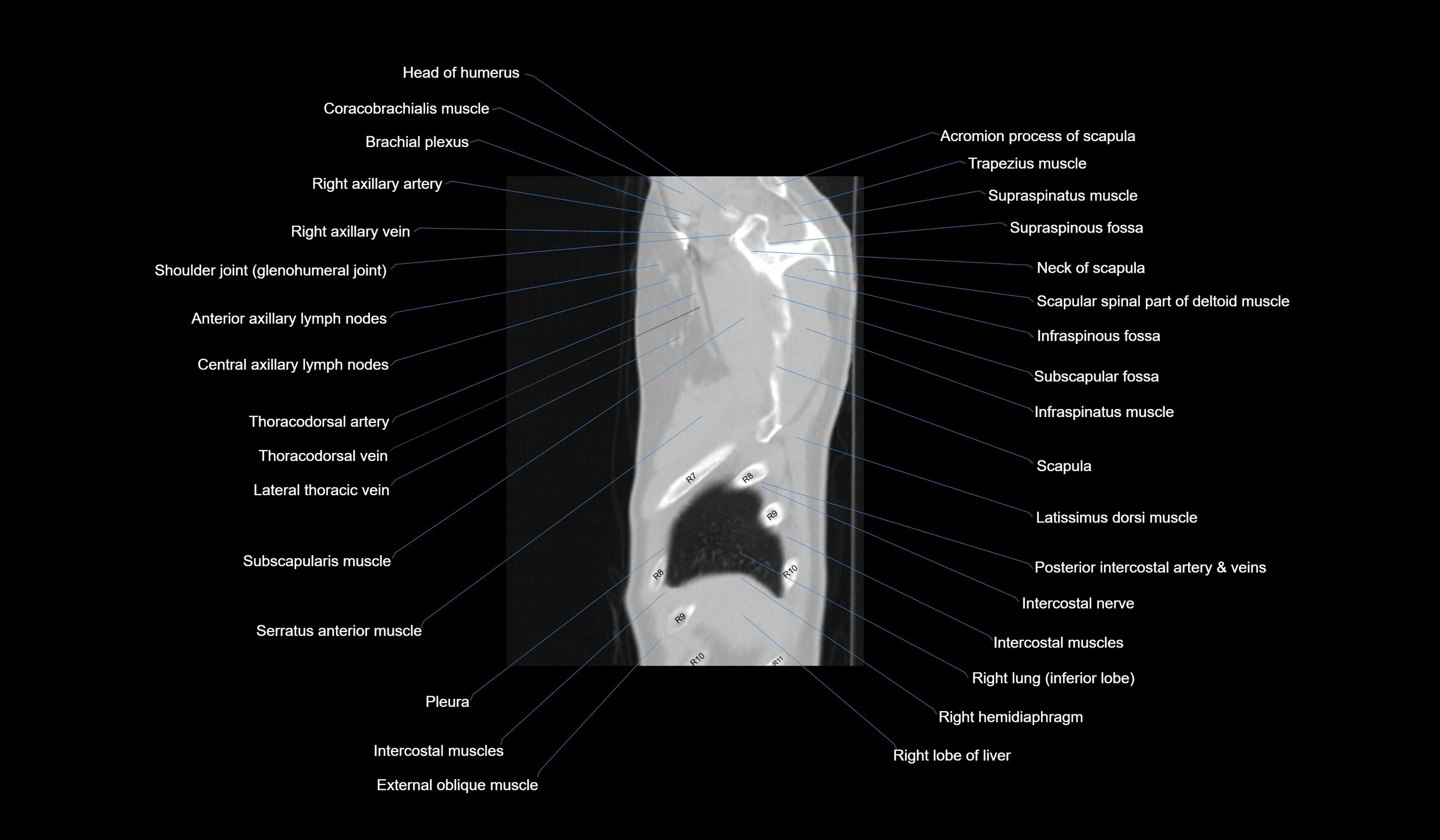 CT chest (thorax) labelled sagittal cross sectional anatomy radiology image-00016.webp